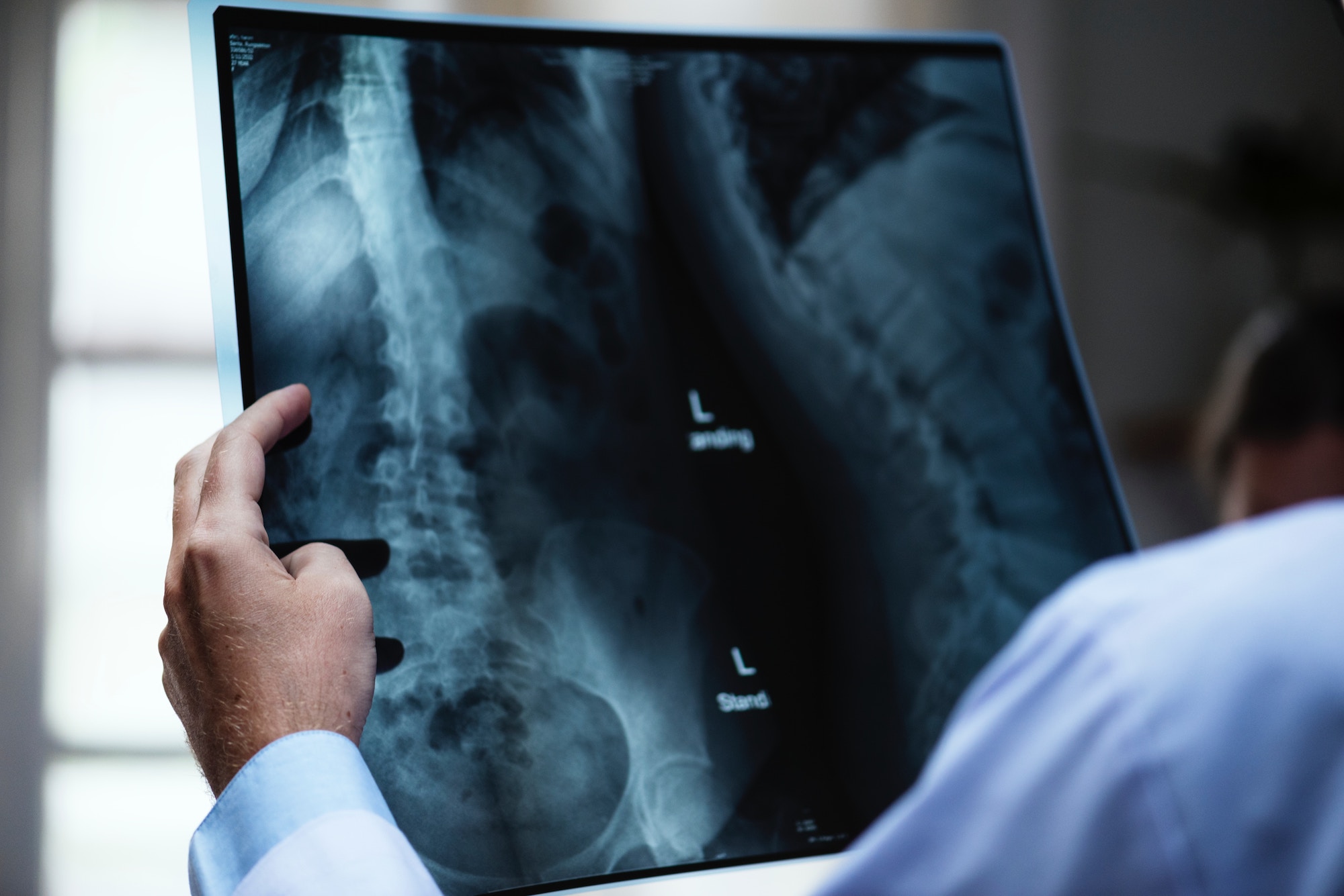 Doctor wearing a lab coat holds an x-ray of a spine